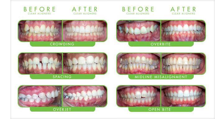 Images of before & after Invisalign Clear Aligners, Fairfax, VA