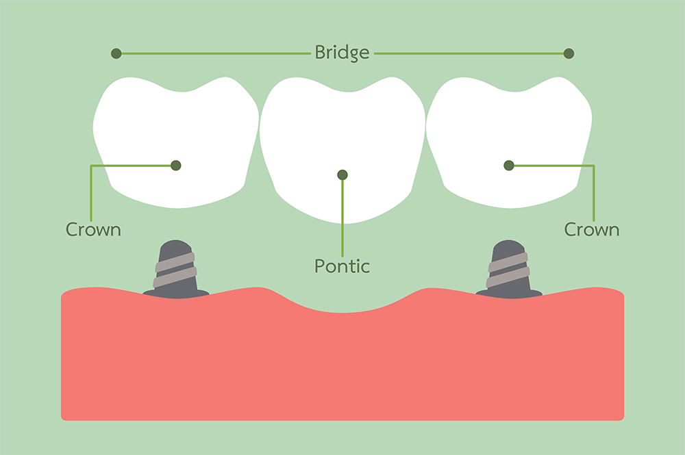 Illustration of Dental Bridges, Fairfax, VA
